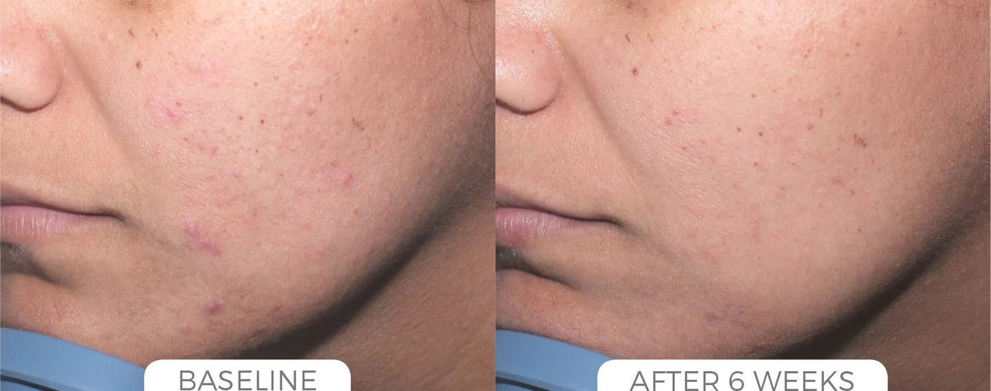 Acne Control System
