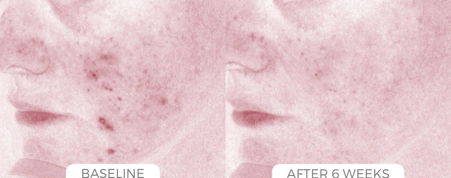 Acne Control System