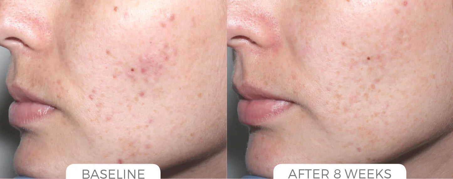 Acne Control System